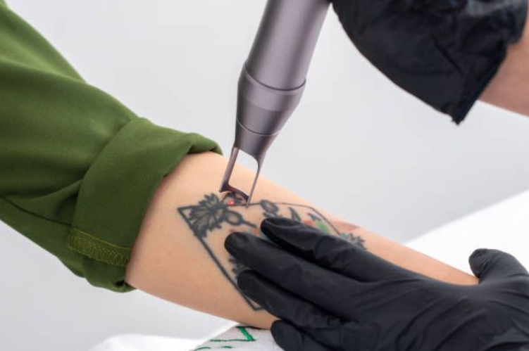 Laser Tattoo Removal