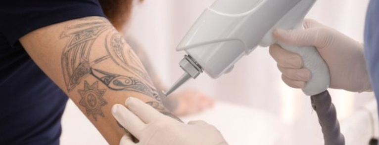 Laser Tattoo Removal